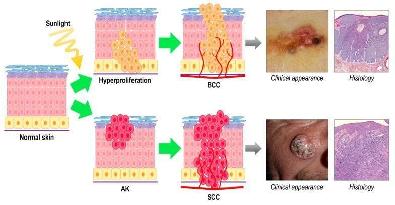 This medical infographic illustrates the progression, clinical presentation, and histology of Non-Melanoma Skin Cancer (NMSC), specifically Basal Cell Carcinoma (BCC) and Squamous Cell Carcinoma (SCC). The diagram starts with 'Normal skin' exposed to 'Sunlight' (UV radiation). The upper pathway shows BCC development originating from interfollicular basal cells, progressing through 'Hyperproliferation' to an invasive 'BCC' mass with prominent angiogenesis. The corresponding clinical photograph displays a pearly, erythematous lesion with ulceration and pigmented areas, while the H&E histology shows characteristic basaloid nests with peripheral palisading and retraction artifacts. The lower pathway depicts SCC development, starting from keratinocytes in the spinous layer, progressing through 'AK' (Actinic Keratosis) to invasive 'SCC'. The SCC clinical photograph shows a hyperkeratotic, crusty, and elevated nodule. The SCC histology reveals disordered epithelial growth, dermal invasion, and keratin pearls. This comparative chart serves as a diagnostic and educational tool for distinguishing these common cutaneous malignancies based on cellular origin, visual morphology, and tissue architecture.