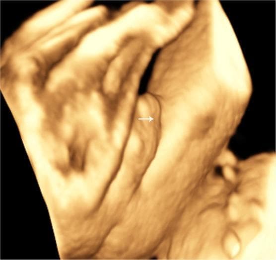 This diagnostic image is a surface-rendered three-dimensional (3D) ultrasound of fetal external genitalia at 28 weeks of gestation, focusing on a ventral view of the penis. The visualization demonstrates a short penile shaft with a distinct structural abnormality. An arrow highlights a shallow, longitudinal groove running vertically along the ventral surface. This finding is characteristic of incomplete fusion of the urogenital folds, a key sonographic marker for fetal hypospadias. The image serves as a clinical example of prenatal diagnostic imaging in obstetrics and fetal medicine, illustrating how 3D ultrasound surface rendering can identify anatomical malformations of the male urethra and penile development. The educational focus is on the detection of urogenital anomalies during routine third-trimester screening.