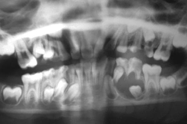 A panoramic dental radiograph (Orthopantomogram) of a pediatric or adolescent patient in the mixed dentition stage. The primary finding is a large, well-circumscribed, unilocular radiolucency located in the left mandibular body. The lesion completely envelopes the crown of the unerupted mandibular left second premolar, with its attachment appearing at the cervical margin (cementoenamel junction), characteristic of a dentigerous cyst. This pathological entity has caused significant inferior apical displacement of the involved tooth bud. Additionally, the adjacent mandibular left second primary molar shows extensive coronal radiolucency indicating deep dental caries with pulp involvement, accompanied by external root resorption and furcation radiolucency. The radiograph illustrates key diagnostic features of odontogenic cysts and the impact of associated primary tooth pathology on developing permanent dentition.