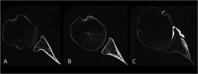This series of three axial CT images of the shoulder joint illustrates subjective morphological variations of the glenoid articular surface at its mid-level. The images demonstrate the relationship between the center of the glenoid fossa and the anterior and posterior articular rims to classify joint concavity. Image A shows a convex glenoid surface, where the center of the bone bulges outward toward the humeral head. Image B depicts a flat glenoid surface, showing a straight linear relationship where the center is level with the articular rims. Image C displays a standard concave glenoid surface, where the center of the fossa is deeper than the surrounding articular rims. These anatomical variations are clinically significant in the assessment of shoulder stability, shoulder hyperlaxity, and glenoid dysplasia. The images highlight the contrast between normal anatomy (concave) and variations found in patients with clinical hyperlaxity (convex or flat), providing educational insight into glenohumeral joint morphology and its impact on joint biomechanics.