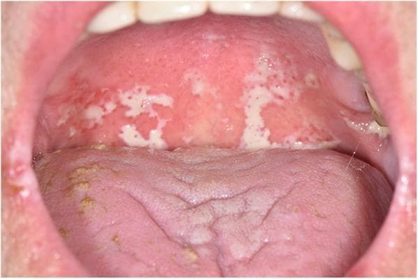 Clinical photograph of the oral cavity showing pseudomembranous candidiasis (oral thrush) in a cancer patient. The image primarily features the soft palate and the posterior oropharynx, which exhibit diffuse erythema (redness) and inflammation. Overlying this erythematous base are multiple, irregularly shaped, creamy-white pseudomembranous plaques characteristic of a fungal infection by Candida species. The plaques appear elevated and adherent but are typically scrapable in a clinical setting. The dorsum of the tongue is visible in the foreground, showing a pink, slightly fissured surface with scattered yellowish-tan patches and mild white coatings. This visual serves as a classic educational representation of opportunistic fungal infections in immunocompromised individuals, such as those undergoing oncology treatments. Key educational concepts include the identification of pseudomembranous lesions, differentiation from other forms of oral candidiasis, and the clinical presentation of oral mucositis superinfection.