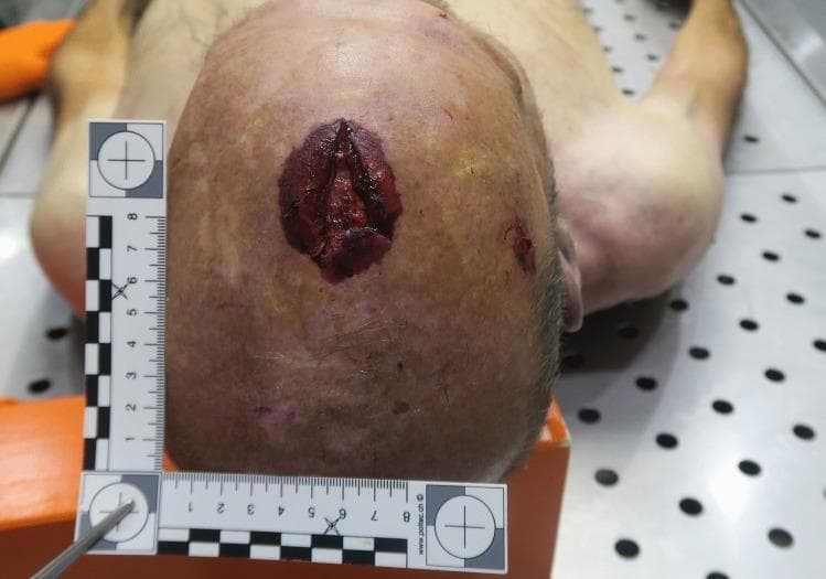 This forensic clinical photograph depicts a close-up, superior view of a human scalp with a significant blunt-force trauma injury, located anterior to the cranial apex in the midline fronto-parietal region. The primary injury is a deep, vertical, roughly triangular laceration measuring approximately 4.5 cm in length. The laceration features irregular, gaping edges with visible blood and subcutaneous tissue. Surrounding the central laceration is a prominent, oval-shaped abrasion and contusion measuring approximately 5 x 3.5 cm, characterized by reddish-purple discoloration and epidermal denudation. A second, smaller, irregular abrasion is visible lateral to the primary wound, anterior to the right ear. A forensic L-shaped scale is placed adjacent to the injuries for dimensional reference. This visual evidence is characteristic of a high-energy impact to the top of the head, often associated in forensic medicine with axial loading injuries such as a Jefferson fracture of the atlas (C1) or other cervical spine traumas.