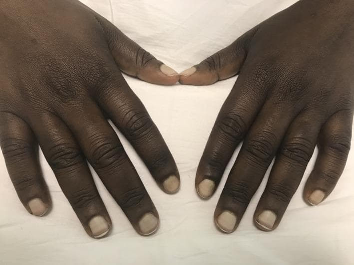 This clinical photograph displays the dorsal surface of both hands in a patient with dark skin pigmentation, demonstrating classic findings of Terry's nails. The fingernails exhibit a characteristic 'ground-glass' appearance, characterized by a diffuse, near-total whitish opacification of the nail bed that obscures the lunula. Distally, a narrow, transverse band of normal pink or brownish-red dermis remains visible (roughly 0.5–3.0 mm wide) just proximal to the free edge of the nail. These changes are indicative of an apparent leukonychia caused by decreased vascularity and increased connective tissue in the nail bed. Clinically, this sign is most strongly associated with hepatic cirrhosis, but may also be seen in chronic heart failure, type 2 diabetes mellitus, and chronic renal failure. The skin over the interphalangeal joints appears slightly thickened with prominent creasing, though no acute dermatological lesions are present. This image is a primary educational resource for internal medicine and dermatology, illustrating nail manifestations of systemic disease.