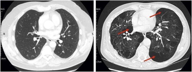 This Comparison Chart features two axial non-contrast Computed Tomography (CT) scans of the thorax at the level of the main pulmonary artery, illustrating different phenotypes of Stage 2 Chronic Obstructive Pulmonary Disease (COPD). The left panel displays a patient with relatively preserved lung parenchyma, characterized by normal attenuation and intact vascular markings without visible emphysematous destruction. The right panel demonstrates advanced structural pathology in a second patient, showcasing significant centrilobular and paraseptal emphysema. Red arrows highlight multiple pulmonary bullae, appearing as focal areas of low attenuation (increased lucency) with thin, well-defined walls, representing localized tissue destruction. A diffuse reduction in vascular density is also evident in the emphysematous lung compared to the normal scan. The educational focus is the radiological manifestation of COPD phenotypes, specifically the correlation between parenchymal destruction, anatomical deadspace volume, and lung inhomogeneity as visualized through diagnostic imaging.