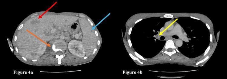 This diagnostic visual consists of two axial contrast-enhanced computed tomography (CECT) images demonstrating multi-organ involvement in a case of disseminated tuberculosis.
Figure 4a (left) shows an axial section of the upper abdomen. Key findings include multiple hypodense lesions in the liver (indicated by the red arrow) and several small, low-attenuation lesions within the spleen (blue arrow), consistent with hepatosplenic microabscesses. Additionally, an orange arrow points to a paravertebral abscess with peripheral enhancement adjacent to the vertebral body, suggestive of spinal involvement.
Figure 4b (right) displays an axial section of the chest in a soft tissue window. A yellow arrow highlights a necrotic right hilar lymph node, characterized by a central area of low density (necrosis) with a surrounding rim of enhancement. The lymph node is located anterior to the right main bronchus and adjacent to the pulmonary artery.
The composite image serves as a clinical teaching tool for identifying extra-pulmonary manifestations of tuberculosis, specifically the radiographic characteristics of visceral lesions, nodal necrosis, and cold abscesses in the setting of disseminated disease.