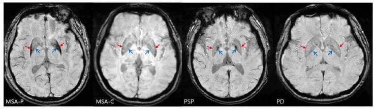 This diagnostic comparison contains four axial Susceptibility-Weighted Imaging (SWI) MRI slices of the brain at the level of the basal ganglia, showcasing differential iron accumulation patterns in Parkinsonian syndromes. The panels compare multiple system atrophy - parkinsonian variant (MSA-P), cerebellar variant (MSA-C), progressive supranuclear palsy (PSP), and Parkinson’s disease (PD). In the MSA-P case, distinctive posterolateral putaminal hypointensity is visible (indicated by closed red arrows), demonstrating a lateral-to-medial signal gradient and significant iron deposition in the lateral globus pallidus. In the PSP image, open blue arrows highlight increased iron-related signals localized to the anterior and medial aspects of the globus pallidus, which serves as a specific diagnostic marker. The MSA-C and PD slices provide a baseline for comparison, showing less pronounced or more diffuse signal changes. These images illustrate key neuroradiological hallmarks used in differentiating atypical parkinsonian syndromes (APS) based on localized mineral deposition in deep gray matter structures.