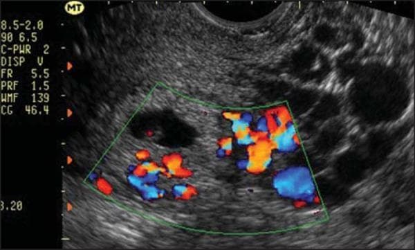 This diagnostic image is a transvaginal ultrasound featuring a sagittal view of the uterus, demonstrating a partial hydatidiform mole. The image shows a heterogeneous intrauterine mass with a classic 'snowstorm' or 'bunch of grapes' appearance, characterized by multiple small, anechoic (black) cystic vesicles representing hydropic villi. A distinct anechoic gestational sac containing a small fetal pole or embryo is visible, which is the key diagnostic feature distinguishing a partial mole from a complete hydatidiform mole. A Color Doppler overlay is applied to a central region of interest, showing prominent vascularity (red and blue signals) within the deciduous and placental tissue, indicating active blood flow. The surrounding myometrium appears intact. This image is used in obstetrics and gynecology to illustrate gestational trophoblastic disease (GTD) and the importance of high-resolution ultrasound in differentiating between complete and partial molar pregnancies based on the presence of fetal tissue and placental morphology.