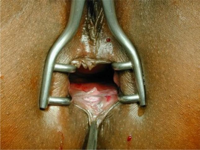 This clinical photograph shows a chronic anal fissure located at the 6 o'clock position in a patient in the supine (lithotomy) position. A metallic Sims (Schulze-Bergmann) rectal speculum is inserted to provide surgical exposure of the anal canal. The fissure is visible as a distinct, longitudinal tear or linear ulcer in the anoderm, surrounded by thickened, inflamed margins and characteristic secondary changes such as a hypertrophied anal papilla or skin tag. The surgical field demonstrates the relationship between the perianal skin, the anal verge, and the internal sphincter fibers. Small amounts of serosanguinous fluid are present on the mucosa. This image serves as a teaching tool for proctology and colorectal surgery, specifically illustrating the preoperative state before a fissurectomy or anocutaneous advancement flap procedure.