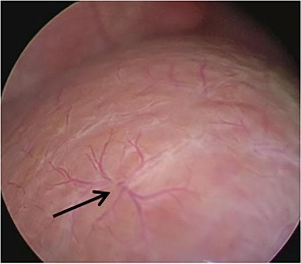 This clinical photograph is a laparoscopic image of the liver surface in a pediatric patient. The imaging demonstrates the 'Hepatic Surface Spider-like Telangiectasia' (HSST) sign, a key diagnostic visual marker for biliary atresia (BA). The liver surface appears relatively smooth and reddish-pink, without overt signs of advanced cirrhosis or nodular fibrosis. A black arrow points to a distinct, tortuous vascular plexus on the capsule. This vascular formation is characterized by a centralized pattern where three or more small, prominent radial branches emerge from a common central point, resembling a spider-like configuration. These telangiectatic vessels are distributed across the liver capsule and are significant clinical indicators used during diagnostic laparoscopy to differentiate BA from other causes of neonatal cholestasis, such as idiopathic neonatal hepatitis or Alagille syndrome, where these specific vascular plexuses are typically absent.