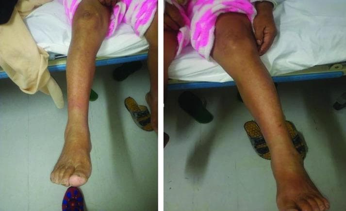 This clinical photograph displays a side-by-side comparison of a patient's lower extremities, illustrating unilateral pathology. The left leg (viewer's right) exhibits significant clinical abnormalities compared to the right leg. Key findings include diffuse erythema (redness) that is most prominent from the distal third of the leg extending down to the dorsal surface of the foot and ankle. There is also evident soft tissue swelling and edema, indicated by the increased girth and loss of definition in the ankle landmarks of the affected limb. The skin appears tense, though no discrete ulcerations or vesiculation are clearly visible in this view. This visual presentation is characteristic of inflammatory or infectious conditions such as cellulitis, deep vein thrombosis (DVT), or localized dependent edema. The image serves as an educational tool for medical students and clinicians to practice visual assessment of inflammatory signs and unilateral limb swelling in a clinical setting.