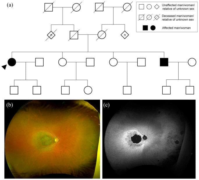 Educational medical composite illustrating autosomal recessive cone-rod dystrophy (CERKL variant). Panel (a) presents a four-generation pedigree chart demonstrating an autosomal recessive inheritance pattern; affected individuals (black symbols) appear in a single sibship from unaffected parents, highlighting the carrier status of ancestors. Panel (b) is a widefield color fundus photograph of the right eye, showing extensive macular atrophy characterized by a central zone of retinal pigment epithelium (RPE) thinning and pigmentary changes. Panel (c) displays widefield fundus autofluorescence (FAF) of the same eye, revealing a central, well-demarcated area of dense hypoautofluorescence (black) indicating RPE loss. This central atrophy is surrounded by a prominent ring of hyperautofluorescence, signifying metabolic stress or accumulation of lipofuscin in the transitioning retinal tissue. These visual findings are hallmark indicators of advanced retinal dystrophy and facilitate the correlation between genetic inheritance and clinical phenotype.