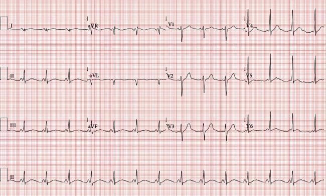 A 12-lead electrocardiogram (ECG) tracing on standard grid paper demonstrating classic features of Wolff-Parkinson-White (WPW) syndrome. The tracing shows a normal sinus rhythm with three primary diagnostic abnormalities: a shortened PR interval (< 120 ms), a wide QRS complex (> 120 ms), and a slurred initial upstroke of the QRS complex, known as a delta wave. The delta wave is most prominent in the precordial leads V3–V6 and the inferior leads (II, III, and aVF). Lead V1 shows a predominantly negative QRS complex, and a QS complex is visible in lead aVL, suggesting the presence of a left anterolateral accessory pathway (ventricular preexcitation). Additionally, secondary repolarization abnormalities are present, characterized by ST-segment depression and prominent, slightly peaked T waves in the inferior and lateral precordial leads. This image is an educational example of ventricular preexcitation and its secondary effects on cardiac electrical morphology.