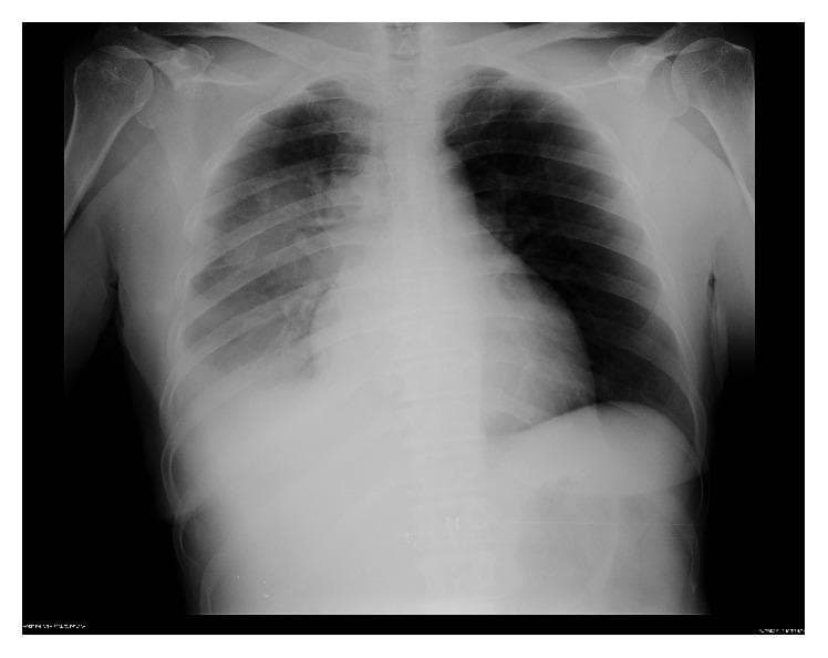 This diagnostic image is a posterior-anterior (PA) chest radiograph. The primary finding is a dense consolidation localized in the right lower lobe, characterized by increased opacity that obscures the right hemidiaphragm and portions of the heart border. Additionally, there are patchy peribronchial opacities extending into the right middle lung zone, following the bronchovascular markings. The left lung field remains relatively clear with normal vascular markings and no evidence of pleural effusion or consolidation. The cardiac silhouette appears within normal limits for size and shape. This radiographic presentation is highly characteristic of community-acquired pneumonia, specifically Legionnaires' disease (Legionella pneumophila), illustrating the progression from patchy infiltrates to denser alveolar consolidation. The image serves as an educational example for identifying unilateral focal pneumonia and distinguishing consolidation from clear lung parenchyma in an acute clinical setting.
