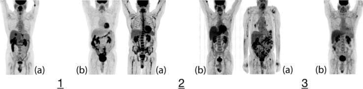 This diagnostic image displays a series of three whole-body Maximum Intensity Projection (MIP) 18F-FDG PET scans (1a, 2a, 3a) paired with age- and sex-matched controls (1b, 2b, 3b) for a comparative study of Polycythemia Vera (PV). The visual focuses on the metabolic activity of the bone marrow. Case 1a exhibits elevated, dispersed FDG uptake throughout the axial skeleton compared to control 1b, alongside incidental avid hepatic and esophageal lesions. Case 2a demonstrates diffuse heterogeneous uptake in both the axial and appendicular skeleton, notably more intense than control 2b, with focal uptake at the gastroesophageal (GE) junction and mediastinum. Case 3a shows more subtle visual differences from its control 3b, although the axial skeleton maintains increased metabolic activity. These images illustrate the hyper-metabolic state of bone marrow in myeloproliferative neoplasms and highlight the utility of functional imaging in identifying both disease-related marrow expansion and co-morbidities such as potential malignancies in secondary sites like the thyroid, lungs, or GE junction.