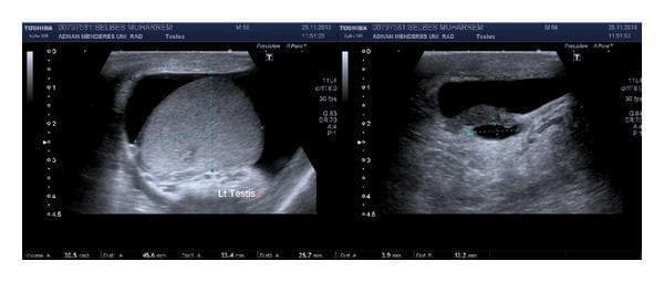 Two grayscale ultrasonographic images of the left hemiscrotum showing a hydrocele and an epididymal cyst. The image on the left displays the left testis ('Lt Testis') with a normal, homogeneous echotexture, partially surrounded by a hypoechoic to anechoic fluid collection consistent with a hydrocele. The image on the right focuses on the paratesticular structures, revealing a well-defined, rounded, anechoic structure within the epididymis, characteristic of an epididymal cyst (spermatocele). There is no significant internal septation or debris visible within the fluid collections. Measurement markers are visible at the bottom of the scans, indicating clinical assessment of testicular and cystic dimensions. This diagnostic imaging illustrates common benign scrotal findings often evaluated in the context of scrotal swelling or urological symptoms like hematuria and flank pain.