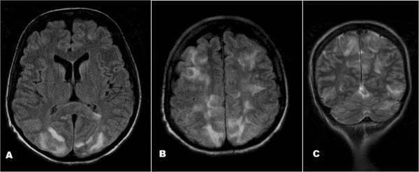 This diagnostic image set consists of three brain MRI sequences (two axial FLAIR images, A and B, and one coronal T2W image, C) demonstrating classic findings of Posterior Reversible Encephalopathy Syndrome (PRES). The images reveal bilateral, largely symmetric, patchy hyperintense lesions within the cortical and subcortical regions. In the axial FLAIR views (A, B), there is prominent involvement of the occipital lobes and frontal-parietal watershed zones. The coronal T2W image (C) further highlights the predilection for the posterior circulation, showing extensive vasogenic edema in the parietal and occipital lobes, as well as the cerebellar hemispheres. These neuroimaging features are consistent with the clinical presentation of acute encephalopathy and seizures, often associated with systemic triggers like hypertension or chemotherapy. The visual data emphasizes the characteristically reversible vasogenic edema pattern that defines RPLS/PRES in a clinical neurology or neuroradiology context.