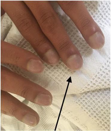 This clinical photograph shows a close-up of a patient's fingers demonstrating classic signs of digital clubbing and peripheral cyanosis. The distal phalanges exhibit a bulbous, 'drumstick' appearance with a noticeable loss of the normal Lovibond angle (the angle between the nail plate and the proximal nail fold). The nail beds appear convex and rounded. A distinct bluish-purple discoloration (cyanosis) is visible across the nail beds and distal fingertips, indicating poor blood oxygenation or circulation. A black arrow points to the most prominent area of clubbing on the index finger. These findings are clinically significant as they often indicate chronic hypoxemia secondary to congenital heart disease (such as Ebstein anomaly), pulmonary disease, or chronic inflammatory conditions. This image serves as a teaching tool for physical examination findings in cardiovascular and respiratory medicine.