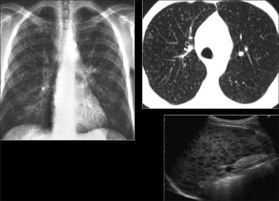 This composite of diagnostic images illustrates a case of disseminated miliary Mycobacterium tuberculosis (MTB) involving the pulmonary and lymphatic systems. The top-left panel is a frontal chest X-ray (CXR) demonstrating diffuse, symmetric interstitial opacities throughout both lung fields. The top-right panel shows high-resolution computed tomography (HRCT) of the lungs, providing a clearer visualization of a classic miliary pattern consisting of tiny (1-3 mm), randomly distributed, well-defined nodules with no predilection for specific lung zones. The bottom-right panel displays a grayscale ultrasound of the spleen, revealing splenomegaly and a heterogeneous parenchymal texture characterized by multiple small, hypoechoic nodules. These splenic findings represent MTB granulomas or microabscesses. Collectively, these imaging modalities depict the typical appearance of 'primary' miliary tuberculosis in an immunocompromised context, highlighting the hematogenous spread of the infection to both pulmonary and extrapulmonary organs.