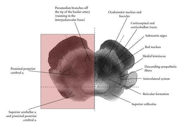 This medical illustration presents an axial cross-section of the human midbrain at the level of the superior colliculus, functioning as an anatomical and vascular diagram. The right side of the image identifies key neuroanatomical structures, including the superior colliculus in the dorsal tectum, the red nucleus and medial lemniscus in the tegmentum, and the substantia nigra situated dorsal to the cerebral peduncle (containing corticospinal and corticobulbar tracts). Also labeled are the oculomotor nucleus/fascicles, descending sympathetic fibers, anterolateral system, and reticular formation. The left side of the diagram is overlaid with shaded regions indicating vascular territories. Three distinct zones are delineated: the medial zone supplied by paramedian branches from the tip of the basilar artery; the lateral zone supplied by the proximal posterior cerebral artery; and the dorsal zone (superior colliculus and tectum) supplied by both the superior cerebellar artery and proximal posterior cerebral artery. This diagram is designed for neurosurgical and radiological education to illustrate the correlation between midbrain vascular supply and clinical stroke syndromes like Weber, Claude, or Benedikt syndromes.