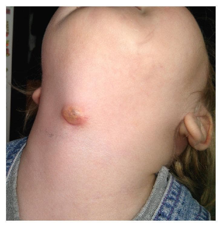 This clinical photograph displays a 2-year-old female patient with a prominent anterior neck swelling, characteristic of an infected thyroglossal duct cyst (TGDC). The lesion is located near the midline in the thyrohyoid region, slightly below the mandibular level. The swelling is approximately 1-2 cm in diameter, presenting as a raised, nodular mass with a circular to oval morphology. The surface exhibits a yellowish-brown crusting and erythema of the surrounding skin, suggesting an inflammatory or infectious process, such as an abscess or a draining fistula. This image serves as a clinical example of a common congenital midline neck mass in pediatric otolaryngology, illustrating the typical presentation of a thyroglossal duct cyst when secondary infection occurs. It is an essential visual reference for differential diagnosis of pediatric neck masses, distinguishing TGDC from other entities like dermoid cysts or lymphadenopathy based on its characteristic anatomical position.