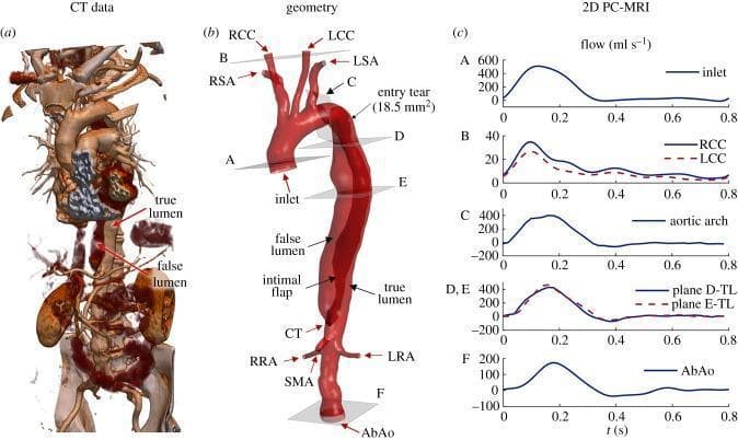 This medical figure presents a multi-modal analysis of a chronic Stanford type B aortic dissection. (a) A CT angiography rendering demonstrates the complex vascular anatomy, highlighting the separation of the true lumen and false lumen by an intimal flap. (b) A 3D reconstructed anatomical diagram details the dissection geometry, originating distal to the left subclavian artery (LSA) and extending through the descending aorta to the abdominal aorta (AbAo). Key supra-aortic branches are labeled, including the right/left subclavian (RSA, LSA) and common carotid arteries (RCC, LCC). Main visceral branches shown include the coeliac trunk (CT), superior mesenteric artery (SMA), and renal arteries (RRA, LRA). A proximal entry tear of 18.5 mm² is identified. (c) Time-resolved 2D PC-MRI flow-rate curves (ml/s) quantify hemodynamic variations across several planes (A–F), including the inlet, supra-aortic branches, and true lumen segments. This figure serves as an educational tool for understanding the pathophysiology and fluid dynamics of aortic dissections.