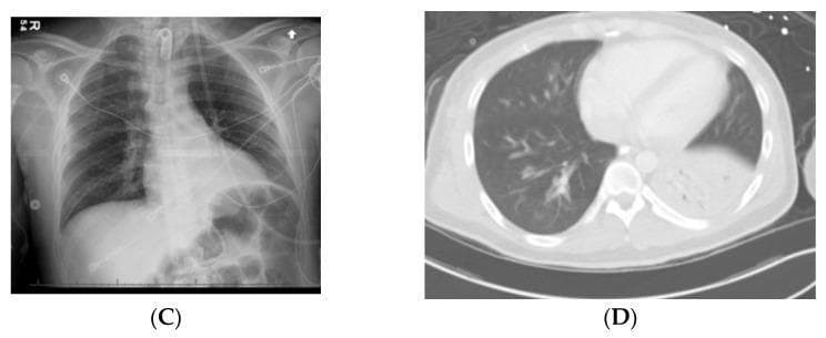 This composite figure displays diagnostic imaging of chest pathologies. Image C is an anteroposterior chest X-ray demonstrating a significantly elevated left hemidiaphragm caused by multiple dilated, gas-filled bowel loops within the upper abdomen, consistent with an opioid-induced ileus. Monitoring leads and a central line are visible. Image D is an axial CT scan of the chest (lung window) showing a dense area of consolidation and volume loss in the left lower lobe, indicative of collapse and persistent pneumonia or aspiration. The right lung remains clear. These images illustrate common secondary pulmonary and gastrointestinal complications in trauma patients with spinal cord injuries, emphasizing the impact of abdominal distention on diaphragmatic position and the radiological presentation of lobar consolidation.