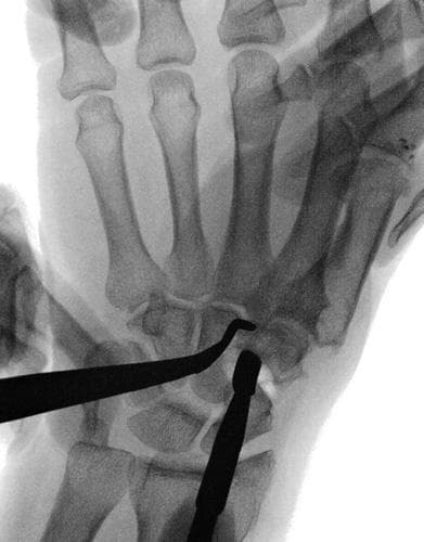 This diagnostic image is an intraoperative fluoroscopic (real-time X-ray) view of the hand and wrist. The field of view focuses on the carpometacarpal region, specifically highlighting the basal joint of the thumb. Visible skeletal anatomy includes the base of the first metacarpal, the trapezium, the scaphoid, and the bases of the second and third metacarpals. Two radio-opaque surgical instruments are present: a curved periosteum elevator positioned superiorly and a straight surgical blade (consistent with a #15 blade) positioned inferiorly. These instruments are shown performing arthrolysis (joint mobilization) of the trapezium. The image demonstrates the spatial relationship between surgical tools and small carpal bones during a trapeziectomy or suspensionplasty procedure for thumb carpometacarpal osteoarthritis. This material is suitable for advanced orthopedic surgical training and demonstrates real-time visualization of joint capsule dissection under fluoroscopic guidance.