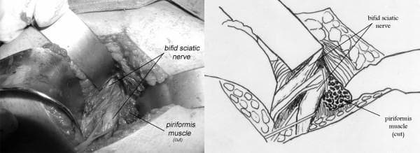 This composite image consists of an intraoperative clinical photograph and a corresponding anatomical line drawing illustrating a variation of the sciatic nerve relevant to piriformis syndrome. The field shows a deep dissection of the right gluteal region. A bifid sciatic nerve is clearly demonstrated, where the nerve is split into two distinct trunks—the common peroneal and tibial components—before exiting the pelvis. These neural structures are seen passing deep to the piriformis muscle. For surgical exposure and decompression, the piriformis muscle is shown as 'cut' (sectioned). The anatomical diagram clarifies the relationship, labeling the bifid sciatic nerve trunks and the hypertrophied, sectioned piriformis muscle. This visual provides clinical evidence of anatomical impingement, where nerve variation combined with muscle hypertrophy can lead to compressive neuropathy. The image is intended for advanced medical education in orthopedics, neurosurgery, and clinical anatomy, focusing on peripheral nerve entrapment syndromes and surgical decompression techniques.