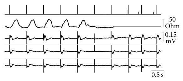 This image presents a multi-channel real-time telemetry recording of a ventricular pacing threshold analysis in VVI mode. It consists of five synchronous tracings: 1) Event markers at the top, where long vertical bars represent ventricular pacing spikes and short bars indicate atrial sensing. 2) Transvalvular impedance (TVI) tracing measured in Ohms (0–50 Ohm scale), serving as a hemodynamic sensor for ventricular ejection. 3–5) Simultaneous surface ECG recordings (leads I, III, and aVR) scaled to 0.15 mV. The sequence illustrates a capture failure at the sixth pacing spike, where the pulse energy falls below the threshold. Visually, the successful pacing in the first five beats is confirmed by periodic TVI waveform rises (indicating mechanical ejection) and wide QRS complexes on the ECG. Upon the sixth spike (capture failure), the TVI tracing remains flat at the diastolic baseline, and the ECG shows a pacing spike without an ensuing QRS complex. The final segments show the pacemaker's response by increasing pulse amplitude to restore effective ventricular stimulation and mechanical capture.