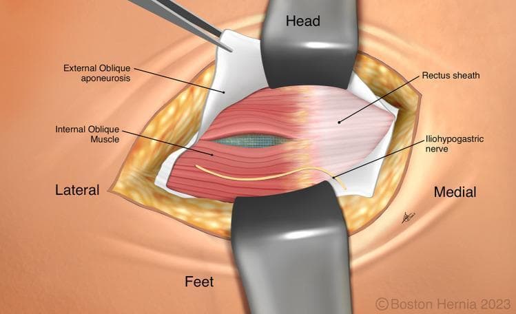 This medical illustration depicts a step in a right inguinal hernia repair (TREPP procedure) showing the abdominal wall layers. The surgical field is oriented with 'Head', 'Feet', 'Lateral', and 'Medial' labels. Retractors and forceps expose the anatomical structures. The external oblique aponeurosis is reflected, revealing the internal oblique muscle. A key feature is the blue surgical mesh visible through a natural split in the fibers of the internal oblique muscle. Medial to this, the rectus sheath is clearly defined. The iliohypogastric nerve is shown coursing superficially across the medial aspect of the internal oblique muscle. The illustration highlights the educational objective of allowing the internal oblique muscles to approximate naturally over the mesh to prevent nerve entrapment or injury by avoiding suturing near the iliohypogastric nerve. This diagram is designed to teach surgical anatomy and mesh placement techniques in preperitoneal hernia repair.