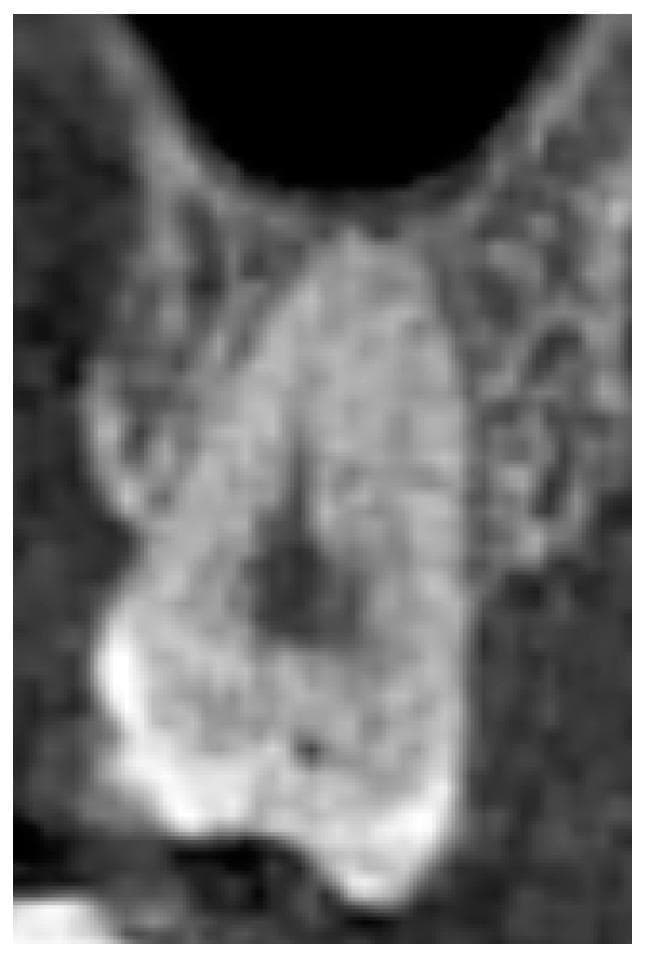 This diagnostic image is a Cone Beam Computed Tomography (CBCT) cross-sectional view of a single human maxillary tooth, used to demonstrate normal dental anatomy. The tooth is positioned within the alveolar bone and exhibits well-defined structural components, including radiopaque enamel and dentin layers. The internal radiolucency represents the healthy pulp chamber and root canal system. There is no evidence of dental caries, periapical radiolucency, or significant periodontal bone loss, with the alveolar crest maintaining a physiological distance from the cementoenamel junction (CEJ). The surrounding trabecular bone displays uniform density. Superior to the tooth, a portion of the maxillary sinus floor is visible, showing a normal relationship between the root apex and the sinus cavity. This visual serves as a reference for a 'healthy tooth' classification in dental and endodontic assessment, emphasizing the absence of pathology in the tooth's hard tissues and supporting structures.