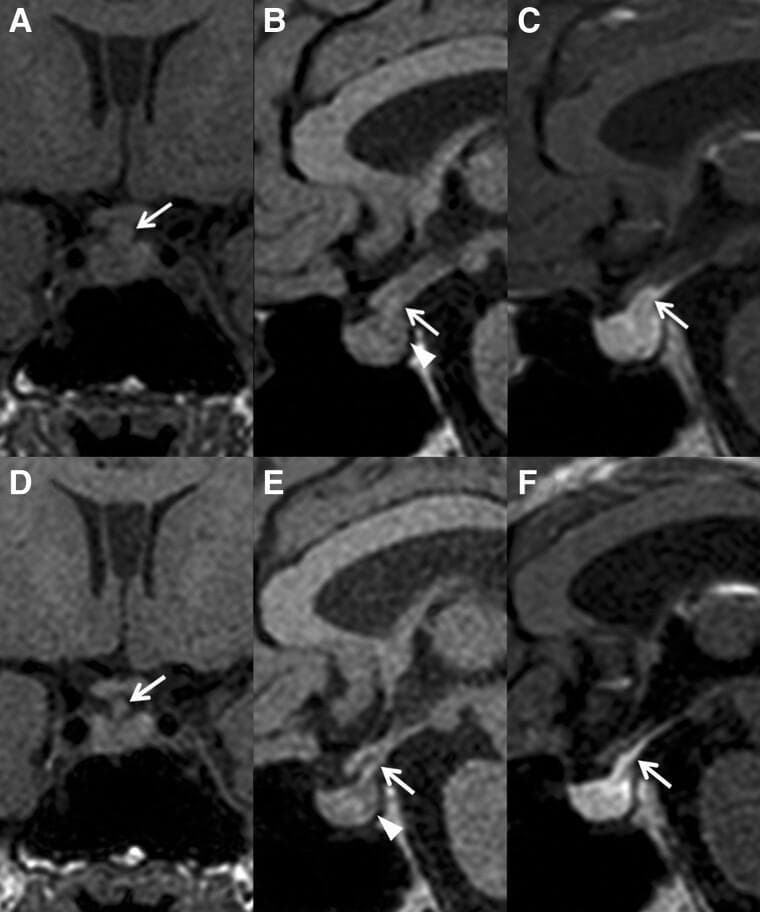 This diagnostic image set consists of six magnetic resonance imaging (MRI) panels of the hypothalamic-pituitary region, illustrating the progression of lymphocytic infundibuloneurohypophysitis (LINH). Panels A-C represent the initial presentation: Coronal (A) and sagittal (B) T1-weighted images show significant thickening of the pituitary stalk (arrows) and the pathognomonic absence of the posterior pituitary 'bright spot' (arrowhead in B). Panel C is a contrast-enhanced T1 image showing rapid enhancement of the enlarged stalk. Panels D-F show a one-year follow-up: There is visible spontaneous regression of the pituitary stalk thickening (arrows in D, E, and F), indicating the self-limiting nature of the inflammatory process. However, sagittal T1-weighted images (E) confirm the persistent absence of the posterior pituitary bright spot (arrowhead), which correlates clinically with chronic central diabetes insipidus. This comparison chart serves as a primary educational tool for identifying the radiological hallmarks of infundibulitis and differentiating spontaneous structural resolution from functional recovery in neuroendocrine disorders.