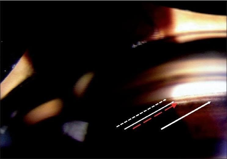 A clinical gonioscopic photograph illustrating the normal anatomy of the human anterior chamber angle. This diagnostic image provides a detailed view of the iridocorneal junction and is used for clinical evaluation of glaucoma and angle status. Labeled structures follow an anterior-to-posterior sequence: Schwalbe's line (dashed white arrow) marks the termination of Descemet's membrane; the pigmented trabecular meshwork (solid white arrow) is visible as a distinct, darker band due to pigment accumulation; the scleral spur (red arrow) appears as a thin, white line representing the posterior attachment of the trabecular meshwork; and the ciliary body (thick white arrow) is seen most posteriorly as a darker band. The image demonstrates the varying pigmentation levels between these structures, which is essential for identifying landmarks during clinical gonioscopy. This material is targeted at medical students and ophthalmology residents for learning anatomical localization and the assessment of an open angle.