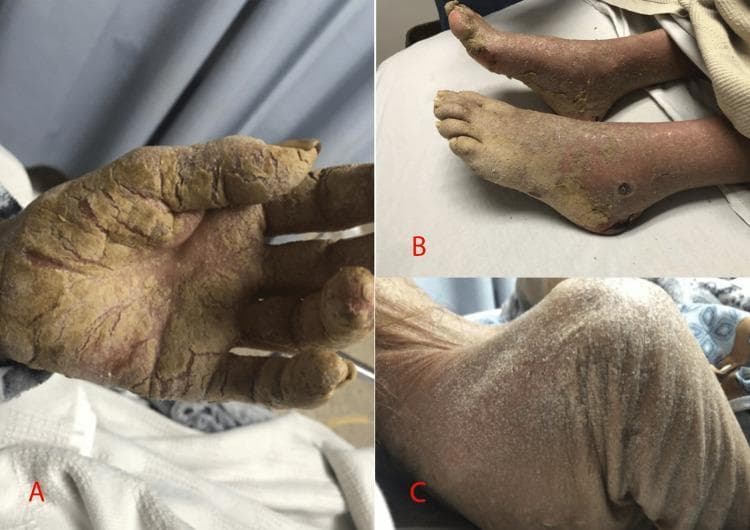 Clinical photograph showing a tripartite display of dermatological manifestations. Panel A illustrates the palmar surface of a left hand covered in thick, yellowish-brown hyperkeratotic plaques with deep, painful-looking fissures and a psoriasiform texture. Panel B displays the bilateral lower extremities with similar hyperkeratotic and crusted lesions predominantly affecting the soles and dorsal aspects of the feet. Panel C depicts the posterior thorax presenting with diffuse, fine, white flaky scales and erythematous patches. Collectively, these features represent a severe generalized dermatosis. The clinical presentation of extensive crusted, fissured, and scaly skin across multiple anatomical regions—hands, feet, and trunk—is characteristic of Crusted (Norwegian) Scabies, particularly in the context of immunocompromise or uncontrolled diabetes. The images demonstrate the transition from heavy keratotic crusting on acral surfaces to widespread scaling on the torso.
