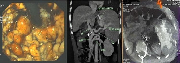 A multi-panel medical image illustrating diagnostic findings of sinistral (left-sided) portal hypertension. The first panel is an upper gastrointestinal endoscopy image showing the gastric fundus with large, tortuous, and protuberant gastric varices (exceeding 10 mm in diameter) featuring high-risk 'red-colored signs.' The second panel is a coronal maximum intensity projection (MIP) CT reconstruction of the abdomen. It highlights venous anatomy, demonstrating attenuated and thrombosed splenic vein (SV) at the hilum, patent portal vein (PV) and superior mesenteric vein (SMV), and prominent gastric varices secondary to the splenic vein occlusion. The third panel is an intraprocedural axial cone beam CT image showing patchy splenic enhancement and metallic artifacts post-partial splenic artery embolization. This composite illustrates the correlation between endoscopic signs of variceal bleeding and the underlying vascular pathology of splenic vein thrombosis often associated with pancreatitis.