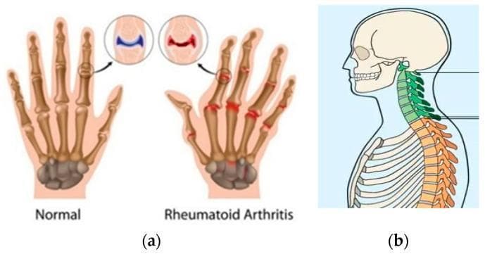 Educational comparison diagrams illustrating musculoskeletal changes in inflammatory arthritis. (a) A comparative anatomical diagram of a normal hand versus a hand with Rheumatoid Arthritis (RA). The normal hand shows clear joint spaces and smooth bone alignment. The RA hand depicts ulnar deviation, swelling of the metacarpophalangeal and interphalangeal joints, and joint space narrowing. Inset circles provide a high-magnification view of a healthy synovial joint versus an RA joint characterized by cartilage erosion and synovial inflammation (pannus). (b) A sagittal anatomical illustration of the head, neck, and upper torso highlighting changes associated with Ankylosing Spondylitis (AS). The cervical spine (green) and thoracic spine (orange) show indicative features of syndesmophyte formation and vertebral fusion, leading to a loss of the normal physiological curvature and the development of a 'bamboo spine' appearance. These visuals are intended to demonstrate the distinctive clinical manifestations and progressive joint degradation found in chronic rheumatological conditions.