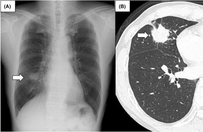 This composite diagnostic image demonstrates a primary pulmonary tumor through two modalities. Panel A is a posterior-anterior chest radiograph showing an ill-defined nodular opacity in the right lower lung zone, marked by a white arrow, representing a suspicious pulmonary mass. Panel B is a transverse (axial) section of a non-contrast chest computed tomography (CT) in a lung window setting. The CT provides superior detail of the same lesion, localized to the right middle lobe. This mass exhibits highly suspicious features including spiculated margins, an irregular shape, and heterogeneous internal density with evidence of micro-cavitation or internal lucency. The surrounding lung parenchyma shows fine linear strands extending from the mass (spiculation), a hallmark of malignancy. These images illustrate the correlation between screening radiography and diagnostic CT in the evaluation of lung cancer. This material is suitable for educating medical professionals on the radiological presentation of solitary pulmonary nodules and the identification of malignant imaging characteristics.