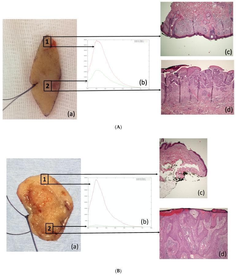 This composite educational image demonstrates the clinicopathological correlation of Autofluorescence (AF) alterations in Non-Melanoma Skin Cancer (NMSC). The image is divided into two primary panels: (A) Basal Cell Carcinoma (BCC) and (B) Squamous Cell Carcinoma (SCC). Both panels follow a consistent structure: (a) Clinical photographs of excised skin specimens with marked control points (1, healthy skin) and lesional points (2, tumor); (b) AF emission spectra showing significantly higher fluorescence intensity in healthy tissue (red line) compared to the tumor (green line), typically peaking at 500 nm; (c) Histopathological sections (H&E stain, 4x magnification) of the healthy skin at point 1, showing normal epidermal and dermal architecture; and (d) Histopathological sections of the malignant lesions at point 2. Panel A(d) illustrates infiltrating BCC with irregular nests of basaloid cells. Panel B(d) displays poorly differentiated SCC characterized by disorganized epithelial proliferation and cellular atypia. This visual resource illustrates how optical biopsy techniques like AF spectroscopy correlate with gold-standard histopathology for diagnosing skin malignancies.
