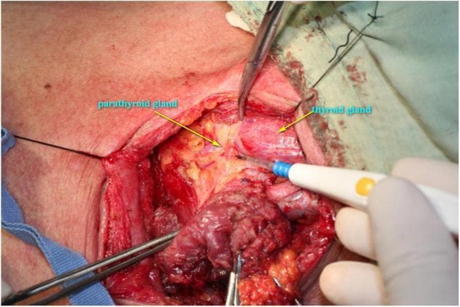 This clinical photograph displays an intraoperative view of a deep surgical dissection in the left lateral neck during a fistula repair procedure. The strap muscles have been retracted or partially removed to expose the visceral compartment of the neck. Key anatomical landmarks are identified with labels: the thyroid gland is visible as a reddish, vascularized lobular structure, and a parathyroid gland is indicated as a smaller, yellowish-tan nodule located on the posterior aspect of the thyroid. The surgical field also demonstrates the recurrent laryngeal nerve pathway and surrounding adipose tissue. Surgical instruments are in use, including an electrocautery probe held by a gloved hand and hemostatic clamps for tissue retraction. The image serves as an educational reference for surgical anatomy of the thyroid and parathyroid glands, nerve preservation techniques, and the management of cervical fistulae. This material is relevant for surgical training in otorhinolaryngology and endocrine surgery.