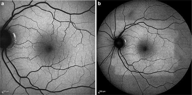 This diagnostic image set consists of two grayscale fundus autofluorescence (FAF) images of a human retina, demonstrating the 'bleaching effect' of rhodopsin. Image (a) is a standard 30-degree field of view FAF showing normal background autofluorescence, the optic disc (nasal dark circle), and retinal vasculature (dark branching lines). Image (b) is a subsequent 50-degree field of view FAF captured immediately after (a). The 50-degree image reveals a central, rectangular, discrete area of relative hyper-autofluorescence. This brighter region corresponds precisely to the 30-degree area previously exposed to the excitation beam in image (a). The phenomenon occurs because the blue light excitation in the first image bleaches the rhodopsin in the rod photoreceptors, reducing its absorptive capacity and thereby increasing the detectable autofluorescence signal from the underlying retinal pigment epithelium (RPE) in the second image. This visual demonstrates the dynamic nature of retinal fluorophores and the importance of light adaptation and sequence in ophthalmic imaging. It is a key educational concept for ophthalmology trainees and retina specialists.