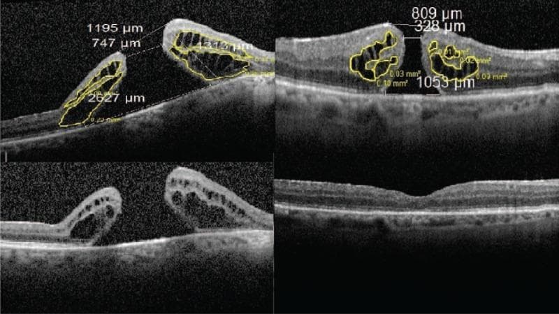 This composite diagnostic image features four Spectral Domain Optical Coherence Tomography (SD-OCT) scans of the human retina, illustrating different stages and outcomes of macular hole (MH) surgery. The top panels show preoperative scans of two different cases (Case 21, left; Case 18, right) with active full-thickness macular holes. These images are annotated with measurements of hole morphology, including basal diameter (e.g., 2627 m vs. 1053 m), minimum top diameter, and height. Yellow outlines highlight intraretinal pseudocysts, with their respective areas calculated (e.g., 0.73 m). The bottom panels demonstrate postoperative outcomes: the bottom-left scan shows anatomical failure with a persistently open macular hole and significant cystic changes seven months post-surgery, while the bottom-right scan shows anatomical success with a closed macular hole and restoration of foveal contour four months post-surgery. These images serve as educational examples of how preoperative macular hole dimensions and the area of perifoveal pseudocysts may correlate with surgical prognosis and anatomical closure.