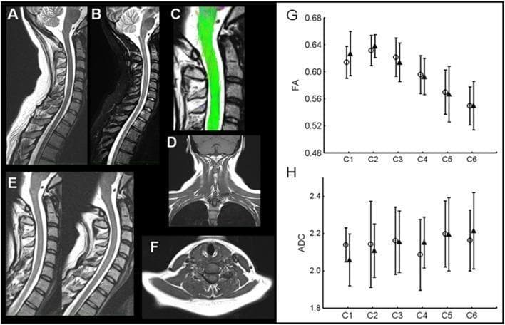 A multi-panel medical figure presenting diagnostic imaging and quantitative data for Whiplash-Associated Disorder (WAD). Panels A-F show anatomical and functional MRI of the cervical spine: (A) Sagittal T2-weighted and (B) STIR sequences; (C) DTI-tractography highlighting spinal cord fibers; (D) Coronal T1-weighted view of the neck; (E) Dynamic T2-weighted sagittal imaging assessing cervical stability; and (F) Axial T1-weighted view of the neck musculature. These images demonstrate an absence of traumatic lesions, fractures, or disc herniation. Panels G and H are comparison charts displaying Diffusion Tensor Imaging (DTI) metrics from cervical levels C1 to C6. Graph G measures Fractional Anisotropy (FA), and Graph H measures the Apparent Diffusion Coefficient (ADC). In both, open circles represent the acute phase and filled triangles represent the chronic phase of WAD. The data indicates no significant change in spinal cord microstructural integrity over time. The figure serves as a clinical example of structural findings in WAD patients at different injury stages.