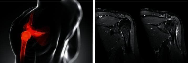 This composite educational graphic focuses on rotator cuff pathology and shoulder anatomy, featuring both an anatomical diagram and clinical diagnostic imaging. On the left, a schematic anatomical diagram of a human shoulder is shown in a coronal-style view; the humerus, scapula, and gleno-humeral joint are highlighted in red against a translucent body outline to indicate the anatomical region of interest, specifically the rotator cuff and subacromial space. On the right, two side-by-side diagnostic images are presented, consisting of Magnetic Resonance Imaging (MRI) scans in the coronal plane. These scans provide high-contrast visualization of the musculoskeletal structures, including the humeral head, acromion process, and the tendons of the rotator cuff (particularly the supraspinatus). The MRI images illustrate clinical findings such as tendon integrity, signal intensity changes suggestive of inflammation or fluid, and joint space morphology. This comparison serves to bridge basic anatomical concepts with real-world radiological diagnosis for orthopedic and sports medicine education.
