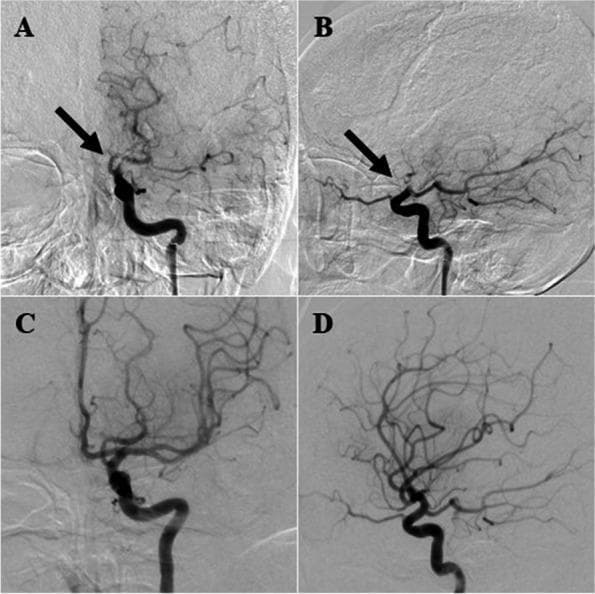 Digital subtraction angiography (DSA) images of the cerebral vasculature illustrating a left internal carotid artery (ICA) occlusion and the result of subsequent endovascular intervention. Panels A (coronal) and B (lateral) represent the pre-thrombectomy state, where black arrows indicate a sharp cutoff and total occlusion of the left ICA. There is a significant lack of contrast opacification in the distal middle cerebral artery (MCA) and anterior cerebral artery (ACA) territories, signifying severe ischemia. Panels C (coronal) and D (lateral) display the post-thrombectomy result, showing successful recanalization of the left ICA. These images demonstrate the restoration of blood flow with a dense, branching network of distal intracranial vessels now fully visualized. The comparison highlights the transition from a large vessel occlusion (LVO) to successful cerebral reperfusion. This material serves as an educational example of diagnostic angiography in acute ischemic stroke and the efficacy of mechanical thrombectomy in restoring cerebral perfusion.