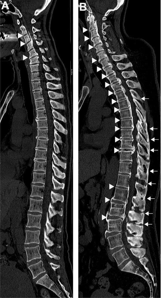 This diagnostic image displays sagittal CT reconstructions of the entire human spine, illustrating two distinct patterns of spinal ligament ossification. Image A demonstrates 'localized' pathology, primarily showing Ossification of the Posterior Longitudinal Ligament (OPLL) confined to the cervical spine region, indicated by white arrowheads. Image B represents a 'diffuse' or systemic involvement, showing multilevel ossification across the entire spinal column. In image B, white arrowheads highlight extensive OPLL and Ossification of the Anterior Longitudinal Ligament (OALL) spanning the cervical, thoracic, and lumbar segments. Additionally, white arrows in the thoracolumbar region of image B indicate concomitant Ossification of the Ligamentum Flavum (OLF) and Ossification of the Supra/Interspinous Ligaments (OSIL). The images serve to contrast localized cervical involvement with generalized spinal ligament ossification, which may be clinically associated with metabolic conditions such as non-alcoholic fatty liver disease (NAFLD) and diabetes mellitus. These radiographic features are critical for diagnosing progressive myelopathy or radiculopathy risks.