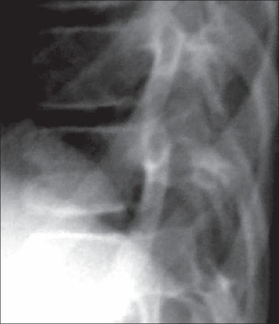 A diagnostic x-ray in lateral projection focusing on the dorsal (thoracic) spine, illustrating a characteristic skeletal abnormality known as 'fishmouth' or biconcave vertebrae. The radiograph reveals significant concavity of both the superior and inferior endplates of multiple vertebral bodies, resulting in a narrowed central height and an expanded appearance of the intervertebral disc spaces. This biconcave morphology is a hallmark finding in several systemic conditions, including progeria (Hutchinson-Gilford Progeria Syndrome), sickle cell disease, and severe osteoporosis. The image also depicts surrounding anatomical structures, including the posterior elements of the vertebrae, pedicles, and portions of the adjacent ribs. Clinically, this imaging modality is used to identify vertebral remodeling and bone density changes in pediatric and adult metabolic bone disorders.