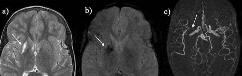 This composite diagnostic image features three panels illustrating neurovascular pathology in a patient with sickle cell disease (SCD). Panel (a) is an axial T2-weighted magnetic resonance image (MRI) of the brain, showing a subtle hypointense 'dark blush' in the right basal ganglia, suggestive of a hemorrhagic infarct. Panel (b) shows the same anatomical section using a T2* gradient-recalled echo sequence; the lesion appears significantly more pronounced as a distinct area of signal void (arrow), demonstrating the sequence's high sensitivity to the magnetic susceptibility effects of blood breakdown products (hemosiderin). Panel (c) is a Time-of-Flight (TOF) Magnetic Resonance Angiogram (MRA) displaying the intracranial vasculature. It reveals severe focal stenosis of the proximal right middle cerebral artery (MCA) (arrow), with a marked reduction in vessel caliber and sparse distal pial vessel filling compared to the contralateral side. These images clinically illustrate silent cerebral infarction and large-vessel arteriopathy, critical complications in pediatric SCD management often screened for via transcranial Doppler.