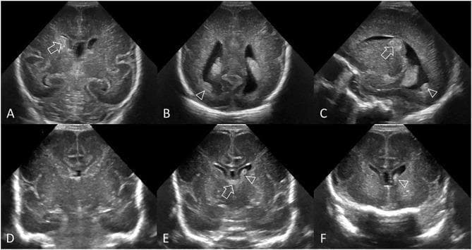 This diagnostic image series consists of six cranial ultrasound (cUS) scans (A-F) in preterm infants, illustrating Grade II germinal matrix hemorrhage-intraventricular hemorrhage (GMH-IVH). Images A-C demonstrate a common pattern in a 26-week gestational age infant. (A) Coronal view shows an echogenic clot involving the caudate nucleus without ventricular dilatation. (B) Coronal view at the trigone shows dependent layering of intraventricular clot. (C) Parasagittal view identifies the clot at the caudothalamic notch and within the occipital horn, distinct from the choroid plexus. Images D-F show a delayed hemorrhage pattern in a 27-week infant. (D) Initial coronal scan at 2 days post-birth appears normal. (E) Follow-up at 6 days reveals a new echogenic clot in the left lateral ventricle and normal choroid plexus in the third ventricle roof. (F) Coronal view anterior to the foramen of Monro confirms intraventricular hemorrhage in the frontal horns. These images serve as educational examples for identifying echogenicity (hemorrhage) within ventricular structures and differentiating it from the choroid plexus for accurate GMH-IVH grading.