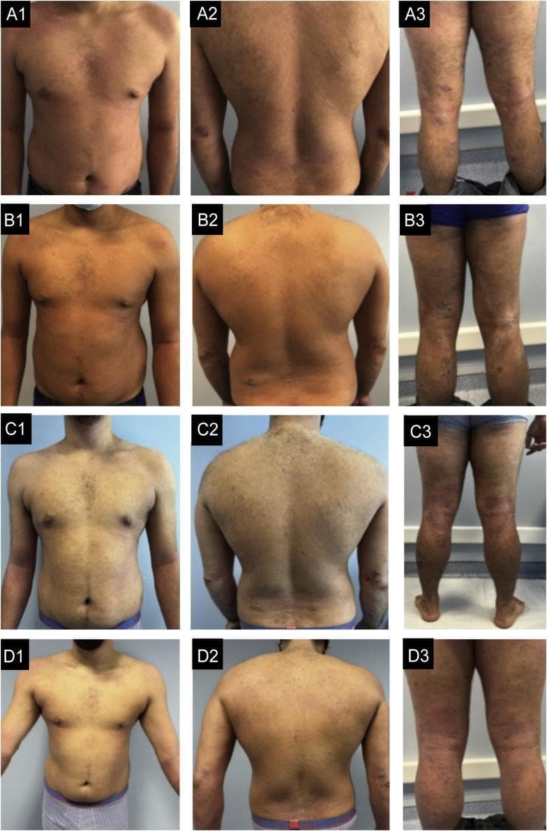 Clinical photograph series documenting the longitudinal progression of severe atopic dermatitis in a male patient across four stages of treatment (A1-D3). The images are organized in a grid showing the anterior trunk, posterior trunk, and posterior lower limbs. (Row A) Basal state: Exhibits widespread severe eczema characterized by extensive moderate erythema and edema on the trunk, with nummular-pattern lesions on the limbs showing intense oozing, crusting, and linear excoriations. (Row B) Post-dupilumab (6 months): Shows minimal clinical improvement with persistent erythema and scaling. (Row C) Post-baricitinib (6 months): Demonstrates lack of response with new inflammatory lesions appearing on the feet. (Row D) Post-tralokinumab (4 months): Displays significant global improvement; the trunk is nearly clear, while the limbs show resolution of excoriations and marked reduction in edema and lichenification. This comparative series illustrates treatment resistance and subsequent successful therapeutic intervention in refractory atopic dermatitis.