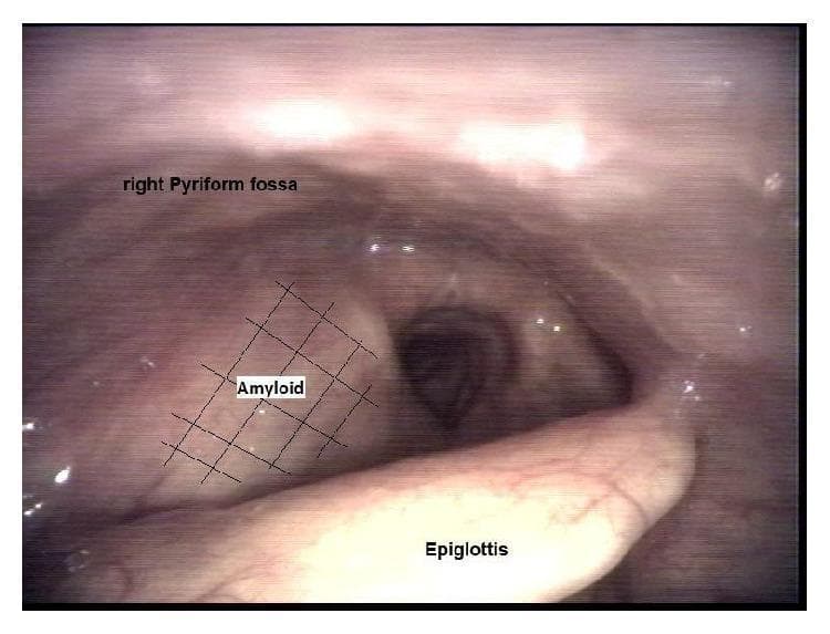 This endoscopic clinical photograph displays the laryngeal anatomy with a focus on the supraglottic region. The image reveals a prominent, smooth, submucosal expansion involving the right aryepiglottic fold and extending inferiorly toward the right ventricular fold (false vocal cord). This mass-like swelling results in the effacement of the right pyriform fossa and significant distortion of the local laryngeal architecture. The overlying mucosa appears intact, translucent, and pale with no evidence of ulceration, friability, or invasive features. Key landmarks are labeled, including the epiglottis in the foreground, the right pyriform fossa, and the localized 'Amyloid' deposition highlighted by a cross-hatched overlay. This finding is characteristic of localized laryngeal amyloidosis, a condition where extracellular protein deposition causes structural hypertrophy and potential airway or deglutition interference. The view is typical for otolaryngology or hematology education regarding the manifestations of systemic or localized plasma cell dyscrasias.